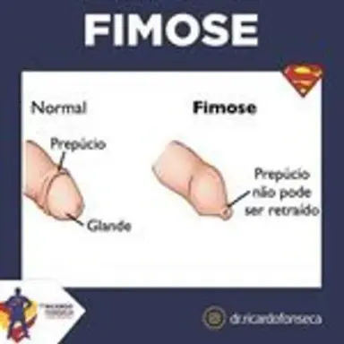 fimose