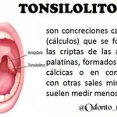 tonsilolito